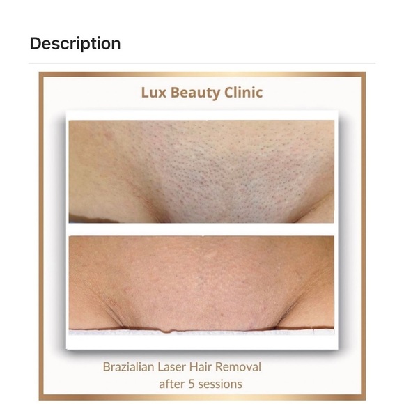 Lux skin permanent laser hair removal main image 6